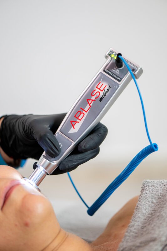 Plasma Lift με Ablase — Valina Skincare & Beauty